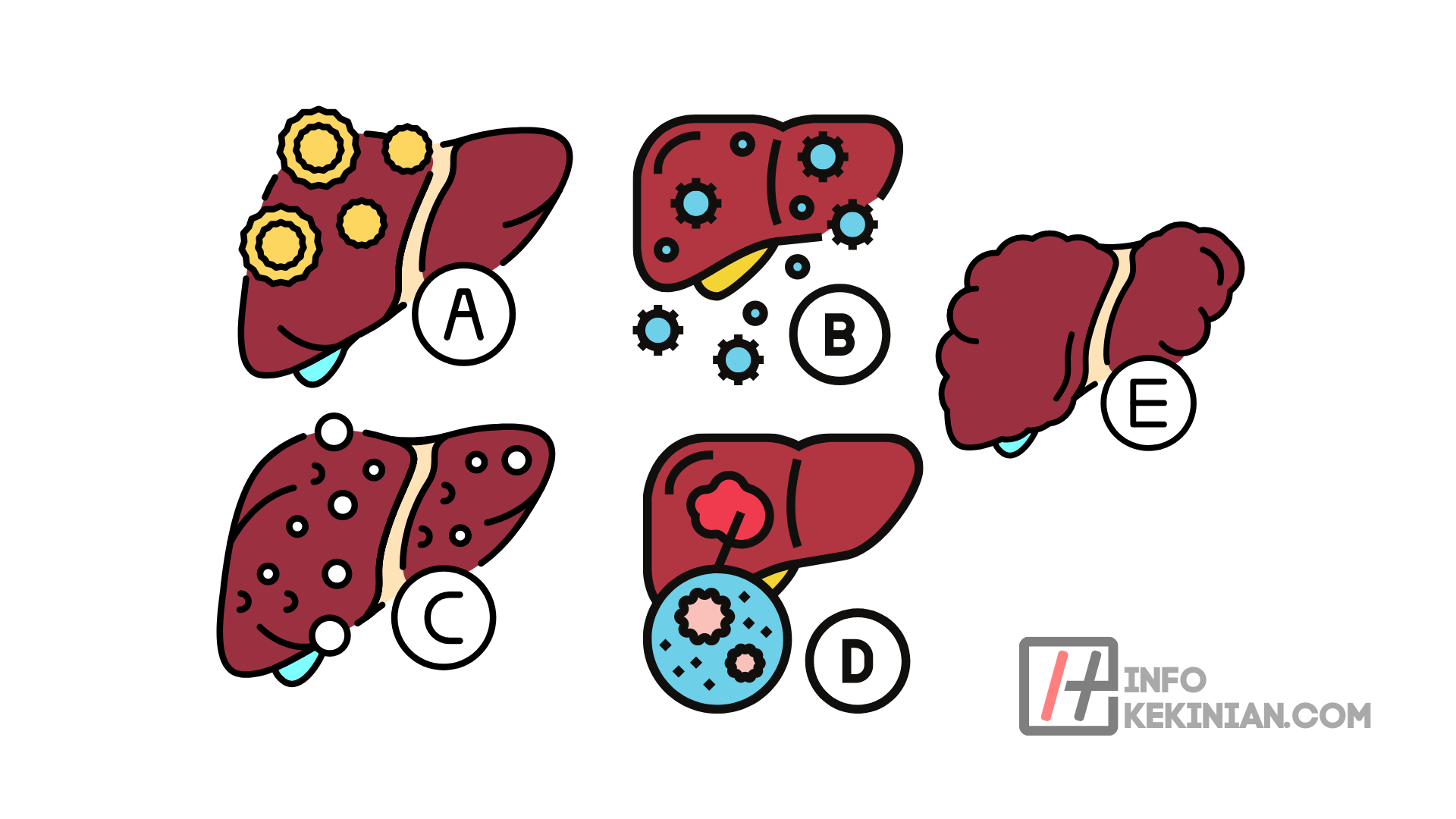 La diferencia entre la hepatitis A, B, C, D y E 1 La diferencia entre la hepatitis A, B, C, D y E