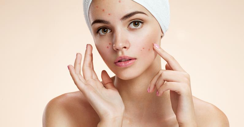 Medicamentos para deshacerse del acné naturalmente