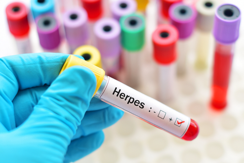 Penyakit Herpes