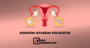 Sindrom Ovarium Polikistik