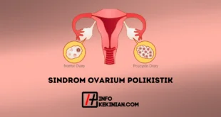 Sindrom Ovarium Polikistik