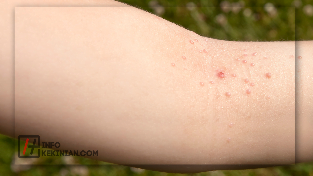 Molluscum Contagiosum