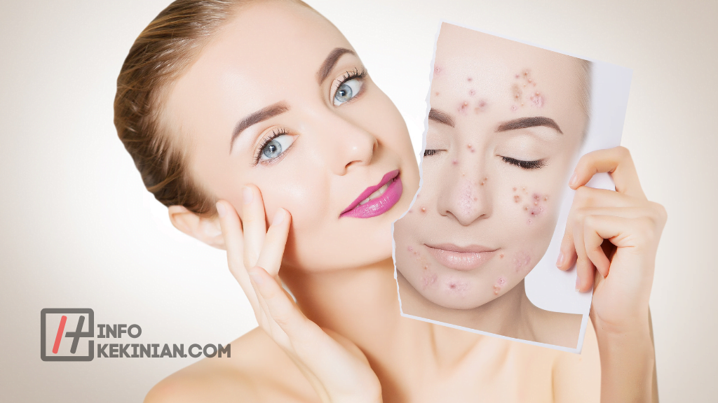 Tips Cara Menghilangkan Jerawat secara Alami dan Ampuh