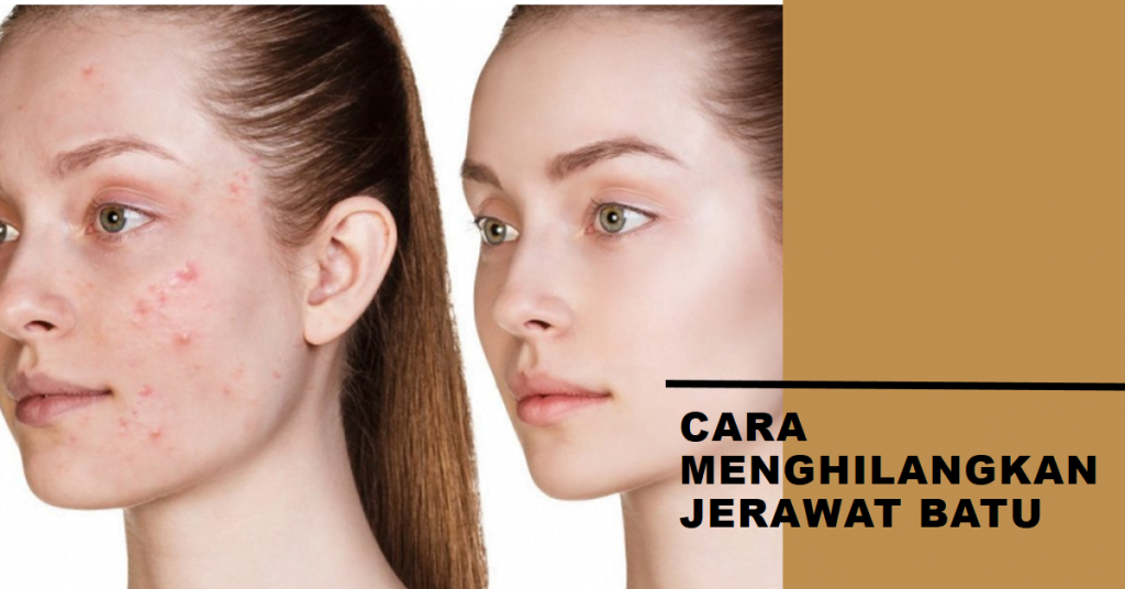 Cara Menghilangkan Jerawat Batu Secara Alami