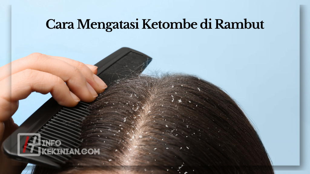 Cara Mengatasi Ketombe di Rambut