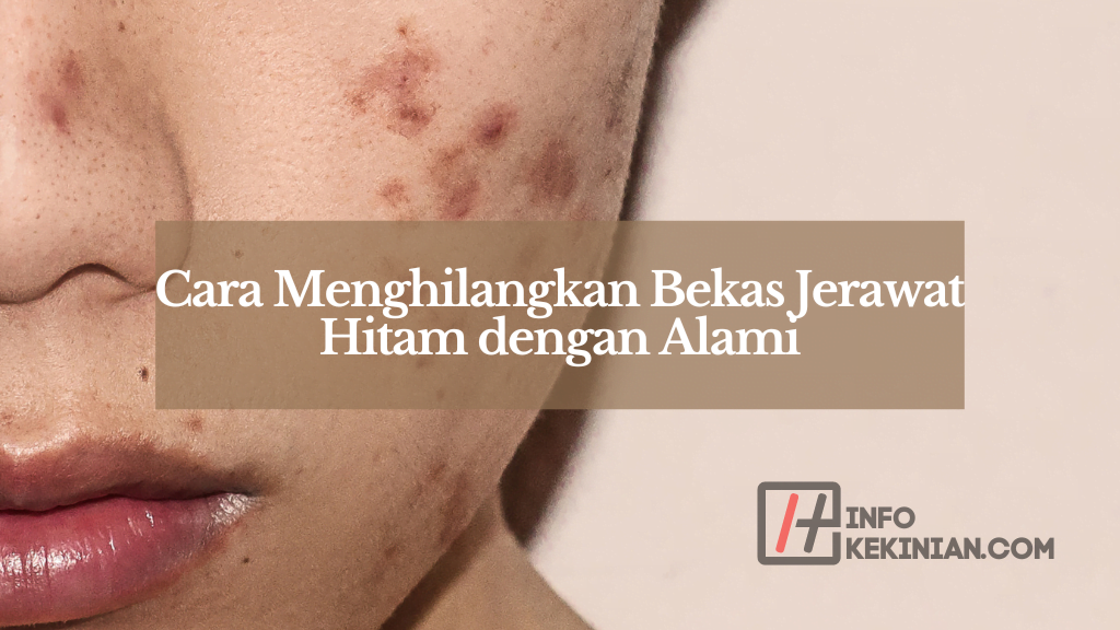 Cara Menghilangkan Bekas Jerawat Hitam dengan Alami