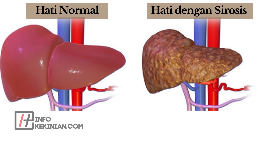 Gangguan Hati dan Penyakit Terkait