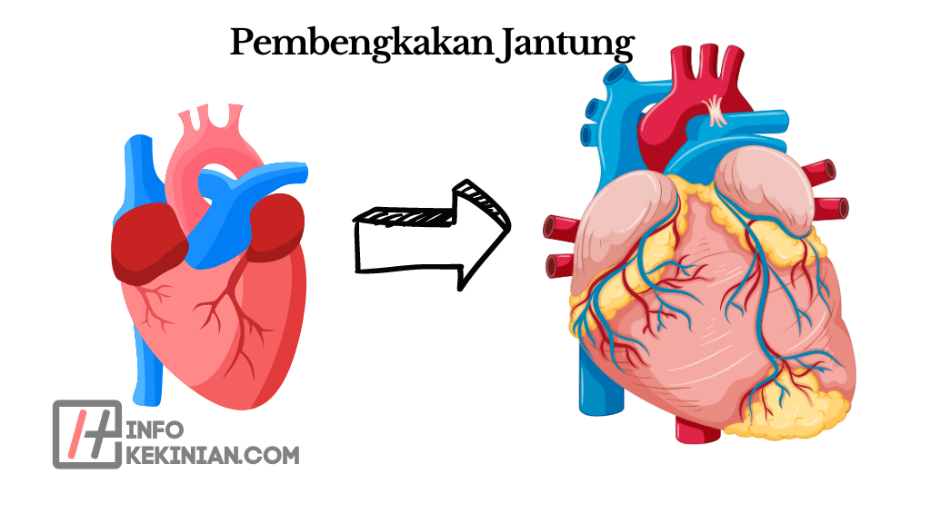 Apa Itu Pembengkakan Jantung