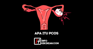 Apa Itu PCOS pada Wanita Gejala, Penyebab, serta Aspek Penting Lainnya