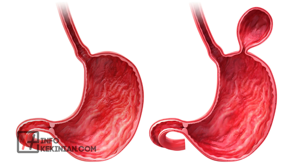 Penyebab Hernia