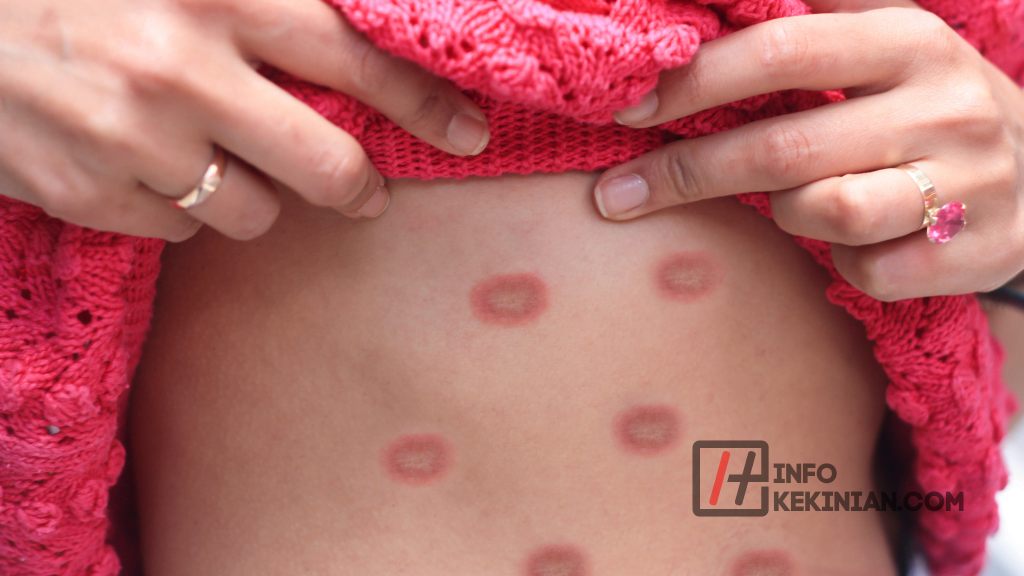 Gejala Mpox